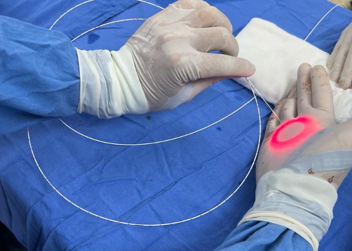 Cirugía de Várices con Tecnología Láser