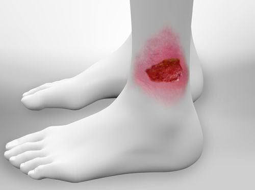 Cuidado Especializado de Úlceras Venosas