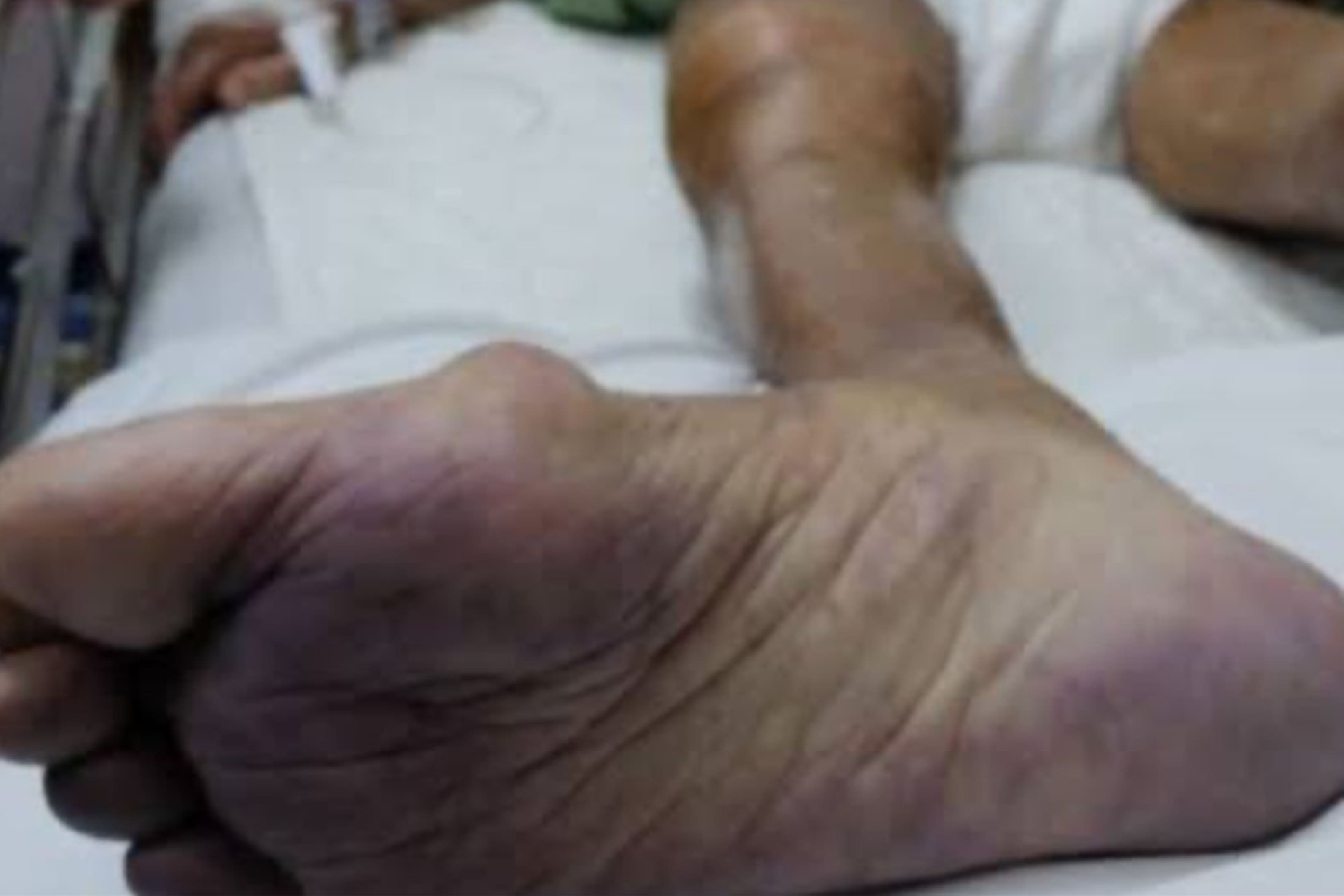 Manejo Especializado de Insuficiencia Arterial Aguda