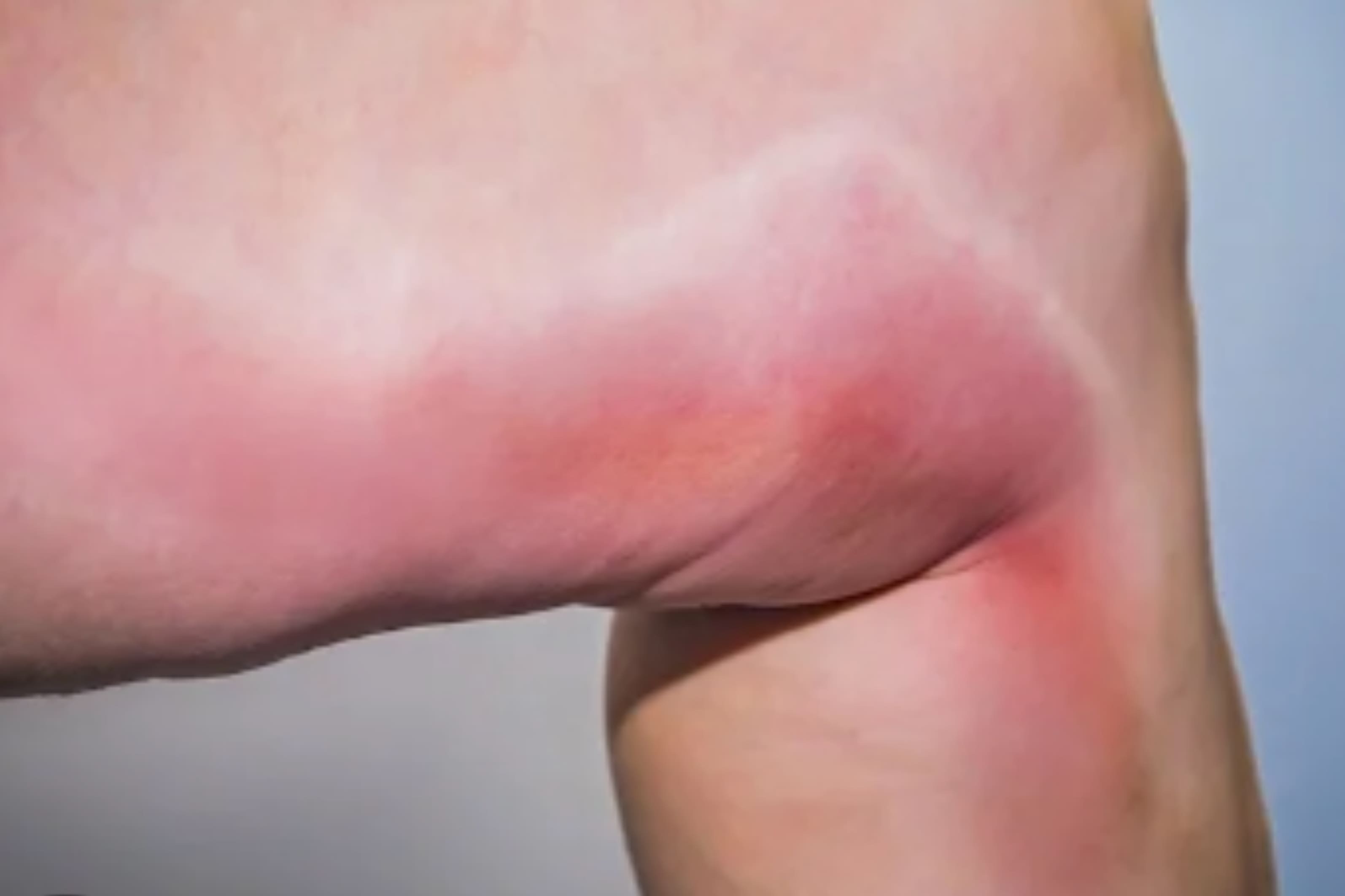 Tratamiento Especializado de Tromboflebitis